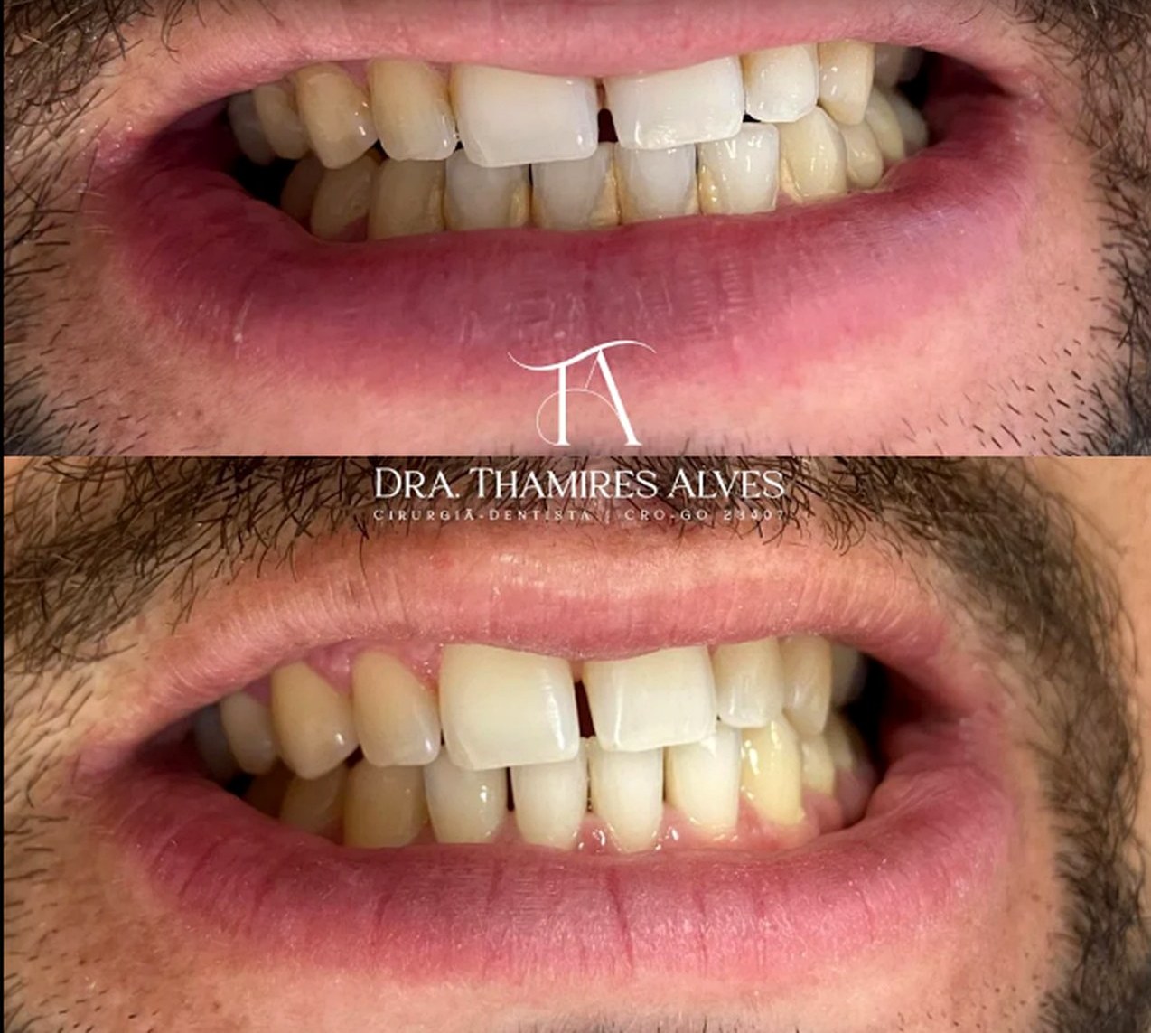 Antes e depois de procedimento odontológico