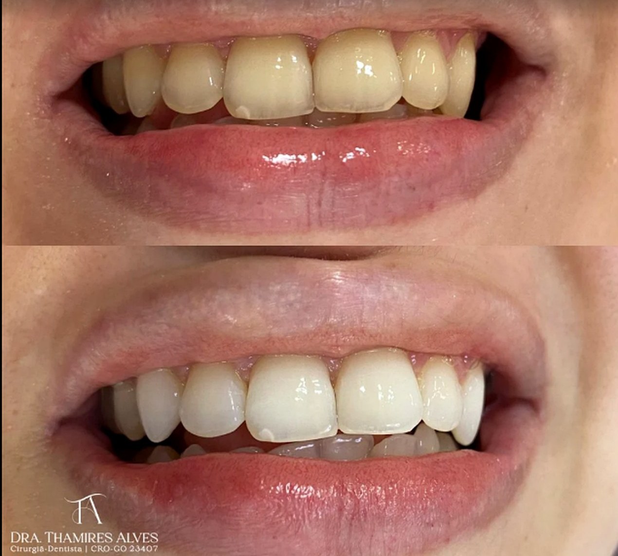 Antes e depois de clareamento e procedimento estético dental